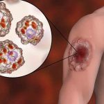 Leishmaniasis