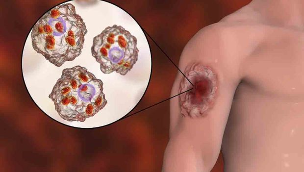 Leishmaniasis