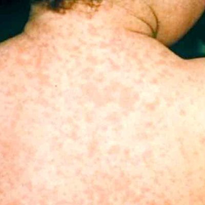 sarampión en Bolivia