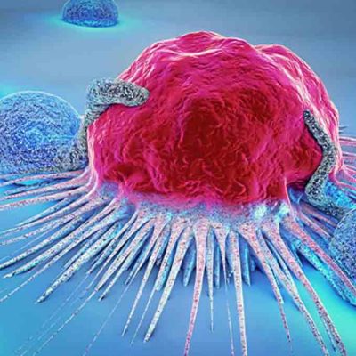 cáncer de mama detección
