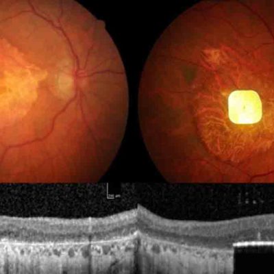 Prótesis ocular permite leer a ciegos