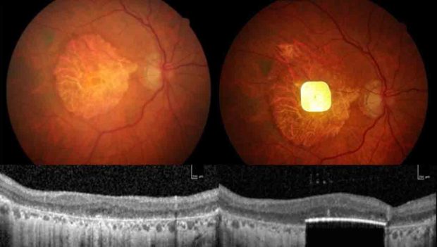 Prótesis ocular permite leer a ciegos