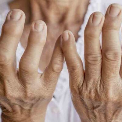 fármaco previene artritis reumatoidea